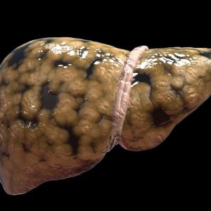 Efinopegdutide beats semaglutide at reducing liver fat in NAFLD patients