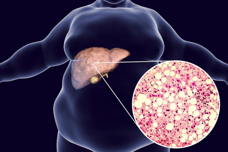 More than half of NASH patients respond to HVPG-guided NSBB prophylaxis