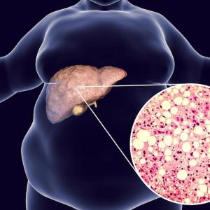 NAFLD risk, remission influenced by lifestyle