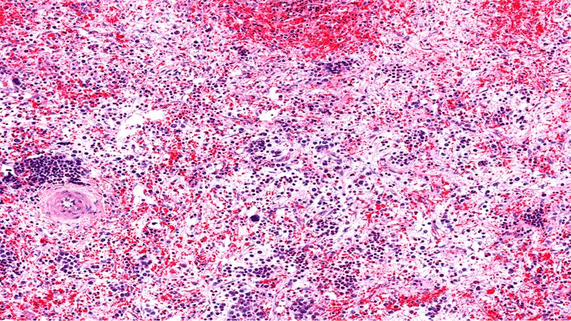 Navitoclax–ruxolitinib combo doubles spleen response rates in myelofibrosis
