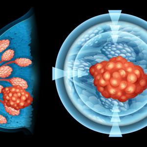 Internal mammary nodes irradiation prolongs survival in breast cancer