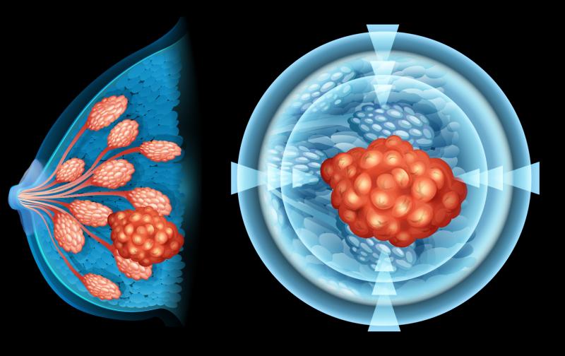 Internal mammary nodes irradiation prolongs survival in breast cancer