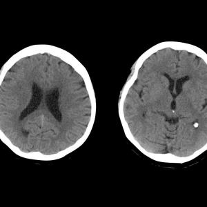 CKD patients with intracerebral haemorrhage face poor prognosis