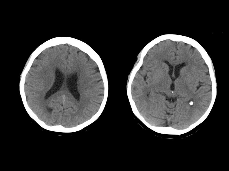 Figure 1. Urgent brain CT upon admission showing no acute ischaemic change or haemorrhage