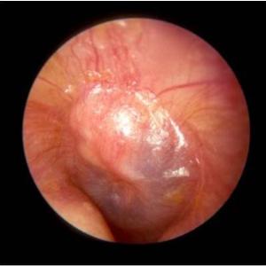 Presence of bacterial otopathogen ups risk of repeat VTI in children with acute otitis media