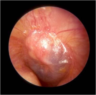 Acute otitis media. (Photo courtesy of Dr Jason Hwang)