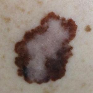 Unmarried patients face shorter survival, later stage at diagnosis of cutaneous melanoma