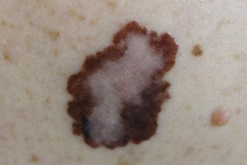 Circulating tumour DNA linked to worse outcomes in melanoma