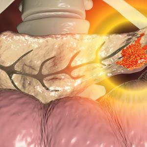 First-line NALIRIFOX regimen ups survival in metastatic pancreatic cancer