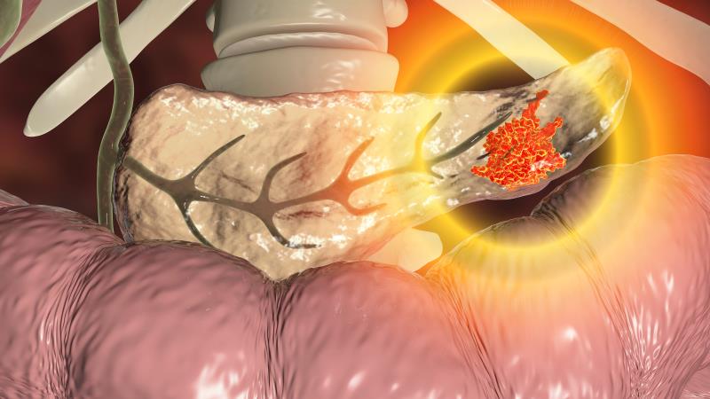 First-line NALIRIFOX regimen ups survival in metastatic pancreatic cancer