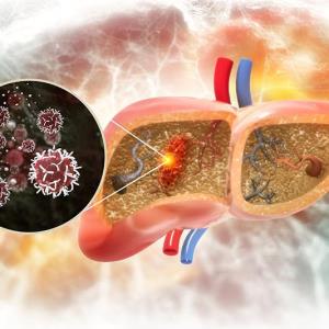 First-line nivolumab-ipilimumab therapy extends survival in unresected HCC