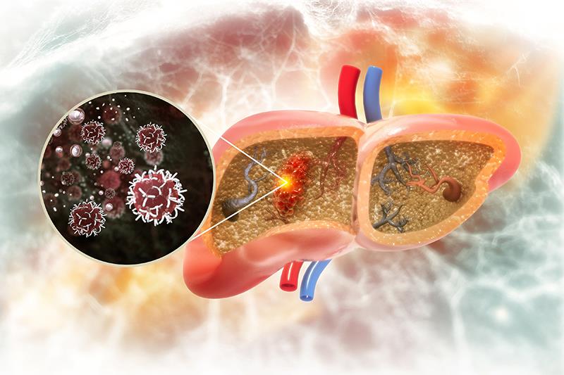 First-line nivolumab-ipilimumab therapy extends survival in unresected HCC