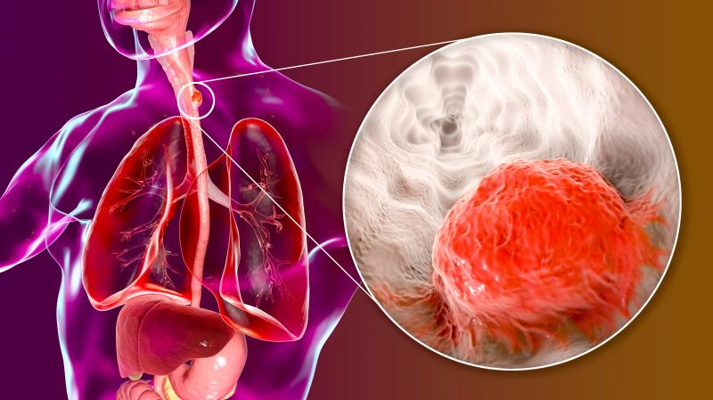 First-line tislelizumab + chemo improves OS in advanced/metastatic ESCC