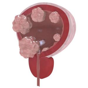 T-cell exhaustion tied to post-BCG recurrence in bladder cancer