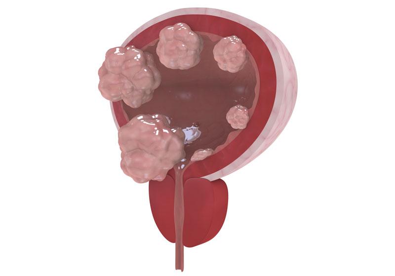 T-cell exhaustion tied to post-BCG recurrence in bladder cancer