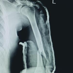 Surgery no better than bracing for humeral fractures