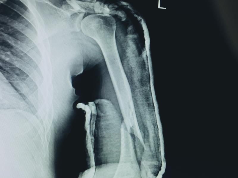 Surgery no better than bracing for humeral fractures