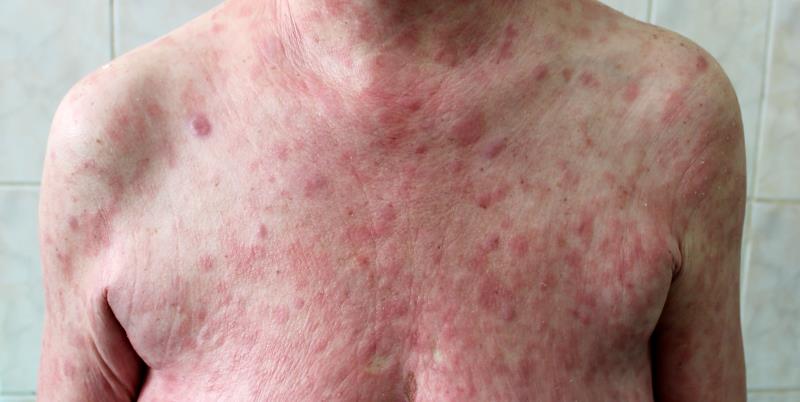 (JM a day ago)FLASH: Light-activated hypericin ointment gets high marks in early-stage mycosis fungoides