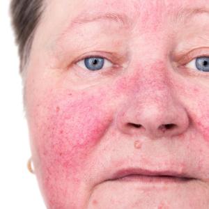 Cryosurgery shines for nonface, nonscalp actinic keratosis