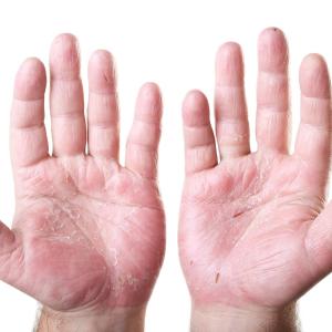 Novel lotion formulation helps reduce palm sweating