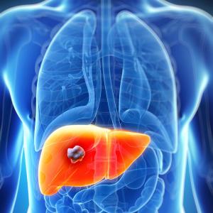 HCC a common liver-related event in successfully treated HCV infection