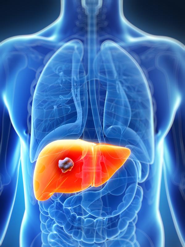 HCC a common liver-related event in successfully treated HCV infection