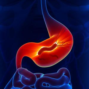 H. pylori Infection tied to short-segment Barrett’s oesophagus in persons without reflux