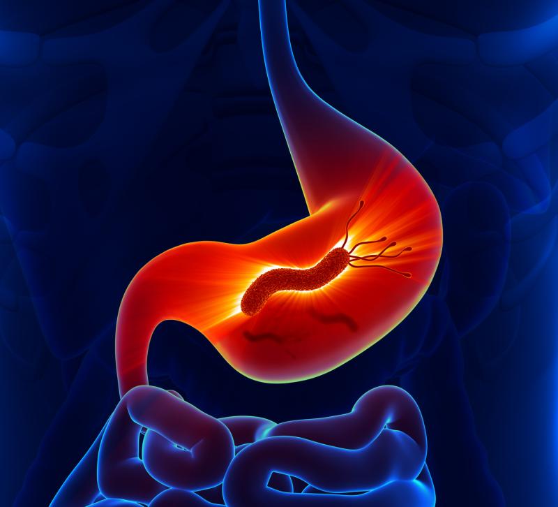 H. pylori Infection tied to short-segment Barrett’s oesophagus in persons without reflux