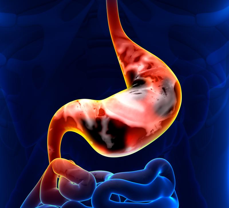 Nine metabolic biomarkers can detect gastric cancer