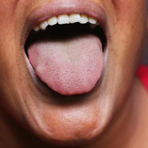 Tongue strengthening exercises boost tongue strength in healthy adults