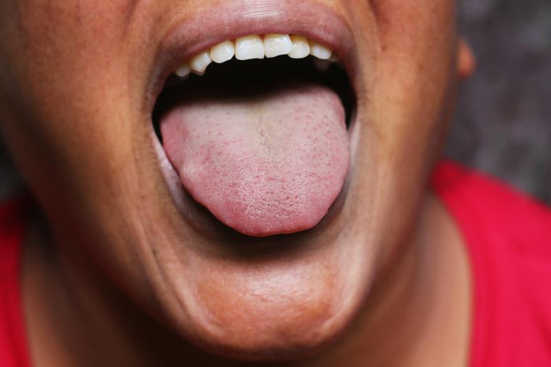 Tongue strengthening exercises boost tongue strength in healthy adults