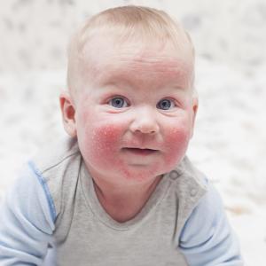 Delgocitinib ointment safely reduces symptoms in paediatric atopic dermatitis