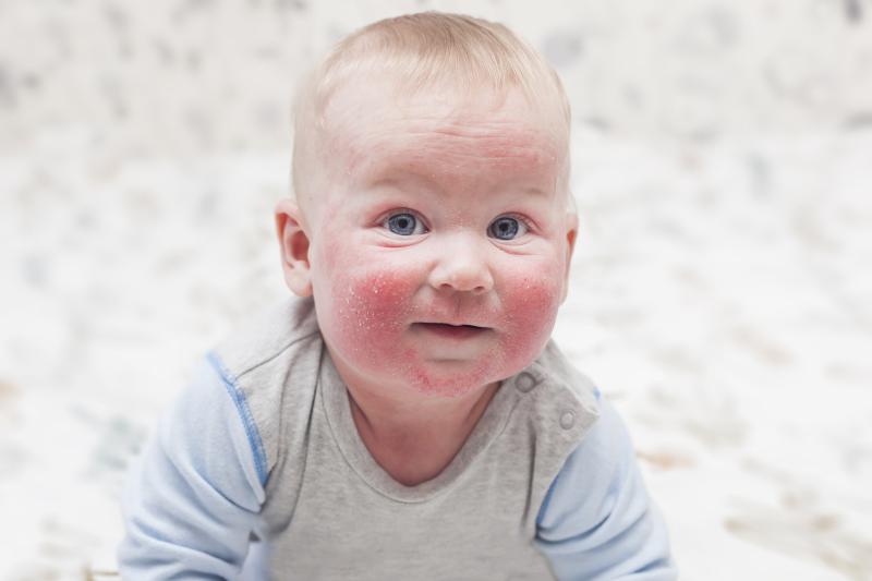 Delgocitinib ointment safely reduces symptoms in paediatric atopic dermatitis