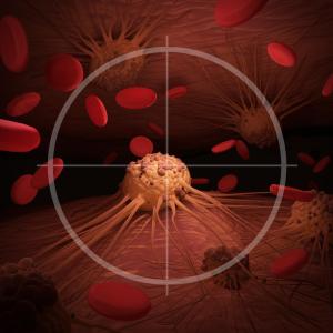 Less aggressive therapy reasonable in primary GI mantle cell lymphoma