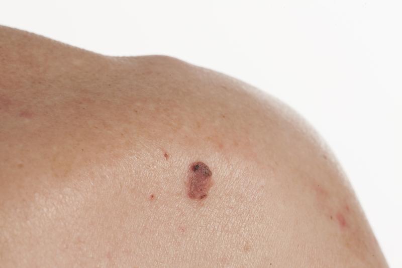 Risk factors for metastatic cutaneous squamous cell carcinoma may help refine staging systems