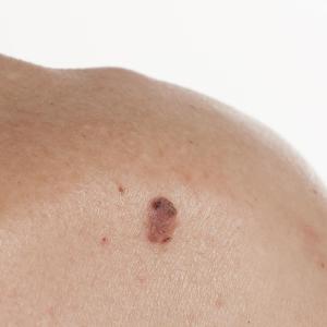 Core outcome set aims to improve basal cell carcinoma trials