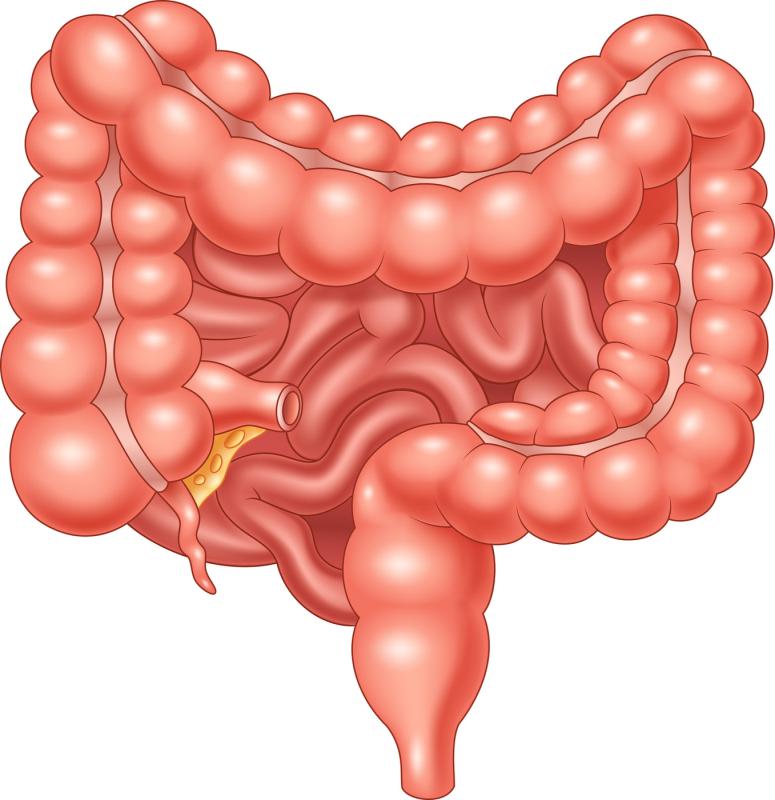 Small bowel adenocarcinoma in coeliac disease: Is the risk real?