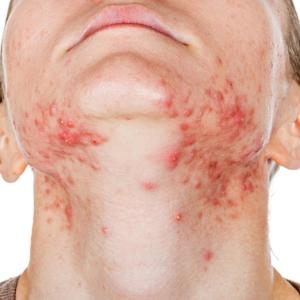 Persistent acne characterized by hyperandrogenic features