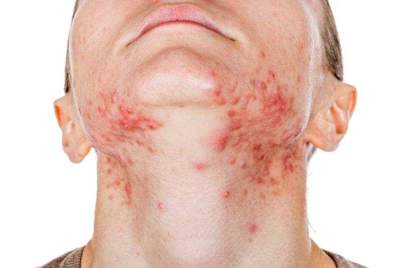 Persistent acne characterized by hyperandrogenic features