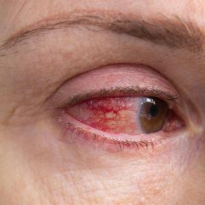 Elevated blood pressure ups retinal vascular occlusion risk