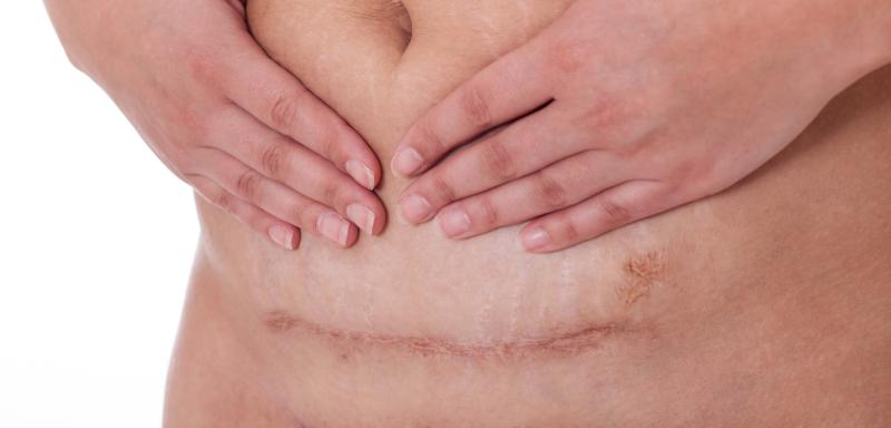 High-dose BTxA safe, yields better scar appearance