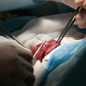 Conditions, surgeries tied to decreased gastric acid associated with SIBO diagnosis