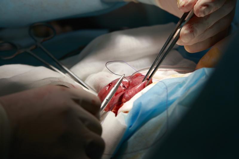 Conditions, surgeries tied to decreased gastric acid associated with SIBO diagnosis