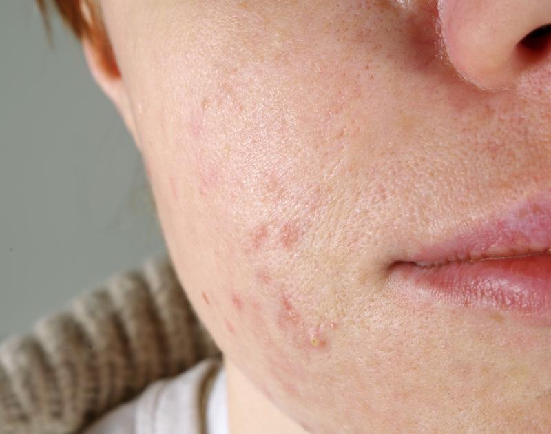 Acne vulgaris linked to insulin resistance