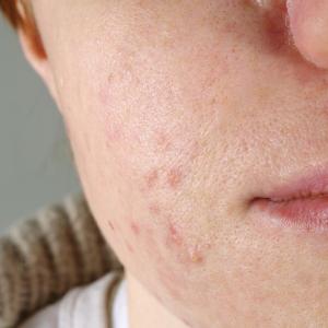 Novel PPARγ modulator shows therapeutic potential in acne vulgaris