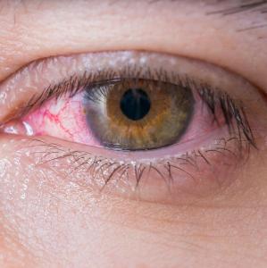 Retinal artery occlusion carries risk of death, adverse cardiovascular events