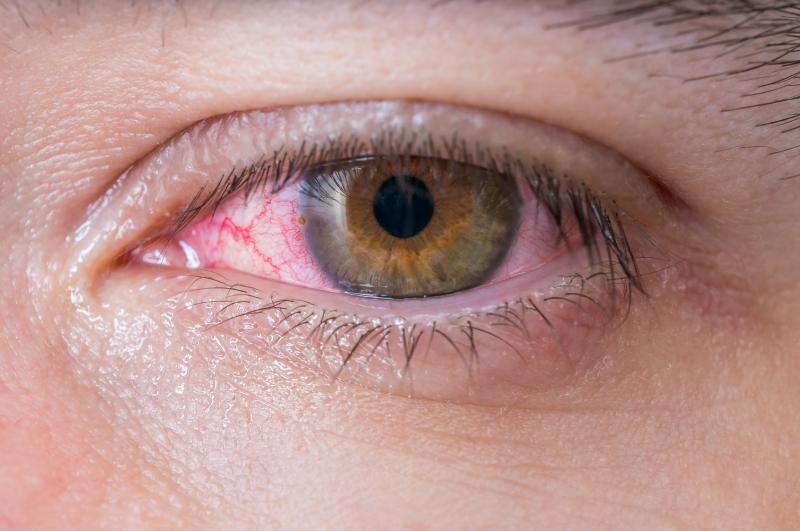 Retinal artery occlusion carries risk of death, adverse cardiovascular events