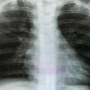 Swimming-induced pulmonary oedema more likely to occur in women, older people