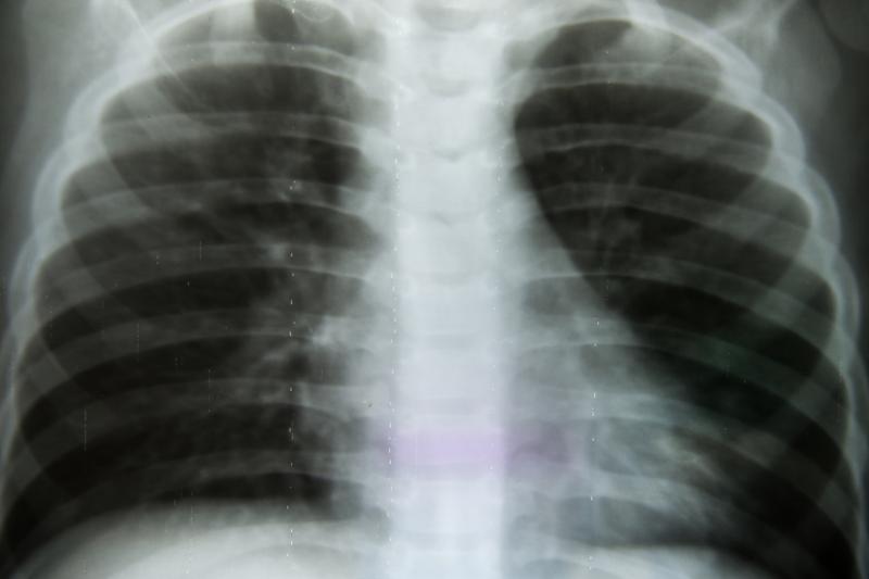 Swimming-induced pulmonary oedema more likely to occur in women, older people