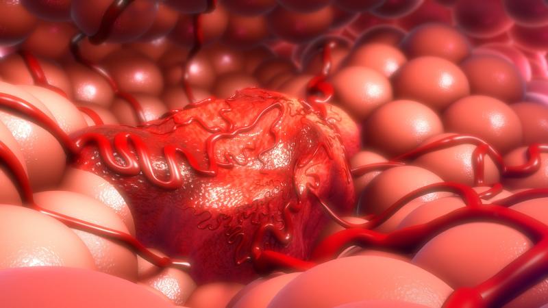 Cytoreductive surgery prolongs survival in metastatic adrenocortical carcinoma